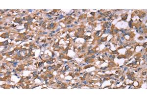 Immunohistochemistry of paraffin-embedded Human thyroid cancer tissue using SPAST Polyclonal Antibody at dilution 1:40 (Spastin antibody)