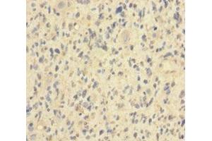 Immunohistochemistry of paraffin-embedded human glioma using ABIN7155411 at dilution of 1:100