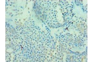Immunohistochemistry of paraffin-embedded human breast cancer using ABIN7159680 at dilution of 1:100 (MICA antibody  (AA 24-307))