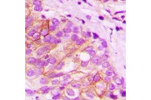 Immunohistochemical analysis of Tapasin staining in human breast cancer formalin fixed paraffin embedded tissue section. (TAPBP antibody  (full length))