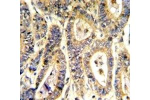 IHC analysis of FFPE human colon carcinoma stained with IGFBP6 antibody (IGFBP6 antibody  (AA 176-200))