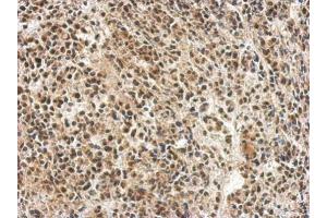 IHC-P Image Immunohistochemical analysis of paraffin-embedded AGS xenograft, using hnRNP 1, antibody at 1:500 dilution. (PTBP1 antibody)