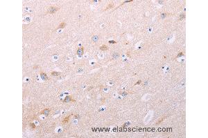 Immunohistochemistry of Human thyroid cancer using ADCY5 Polyclonal Antibody at dilution of 1:40 (ADCY5 antibody)