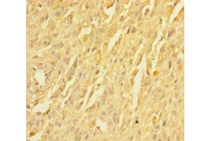 Immunohistochemistry of paraffin-embedded human melanoma using ABIN7173027 at dilution of 1:100 (TMEM19 antibody  (AA 34-83))