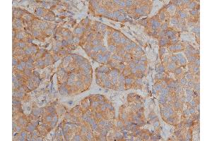 ABIN6268839 at 1/200 staining human breast cancer tissue sections by IHC-P. (BIM antibody  (N-Term))