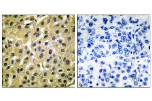 Immunohistochemical analysis of paraffin-embedded human breast carcinoma tissue, using MDM2 antibody (ABIN5976454). (MDM2 antibody  (C-Term))