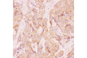 Anti-AAMP Picoband antibody,  IHC(P): Human Mammary Cancer Tissue (AAMP antibody  (AA 235-434))