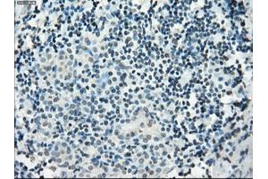 Immunohistochemical staining of paraffin-embedded Adenocarcinoma of colon tissue using anti-PDE10A mouse monoclonal antibody. (PDE10A antibody)