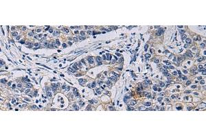 Immunohistochemistry of paraffin-embedded Human gastric cancer tissue using CHST3 Polyclonal Antibody at dilution of 1:35(x200) (CHST3 antibody)