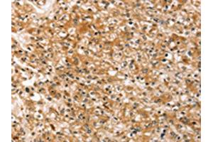 The image on the left is immunohistochemistry of paraffin-embedded Human prostate cancer tissue using ABIN7192485(SLC40A1 Antibody) at dilution 1/20, on the right is treated with synthetic peptide. (Band 3/AE1 antibody)