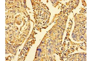 Immunohistochemistry of paraffin-embedded human cervical cancer using ABIN7150882 at dilution of 1:100 (DYNLL1 antibody  (AA 1-89))