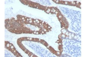 Formalin-fixed, paraffin-embedded human Colon Carcinoma stained with Cytokeratin 20 Mouse Monoclonal Antibody (KRT20/3145). (KRT20 antibody  (AA 196-323))