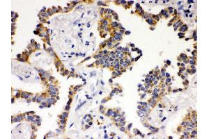 Anti- ATG14L Picoband antibody, IHC(P) IHC(P): Human Lung Cancer Tissue (ATG14 antibody  (N-Term))
