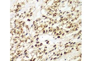 Immunohistochemistry of paraffin-embedded Human kidney cancer using SMAD9 Polyclonal Antibody at dilution of 1:100 (40x lens). (SMAD9 antibody)