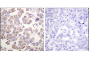 Immunohistochemistry analysis of paraffin-embedded human breast carcinoma tissue, using WNT1 Antibody.