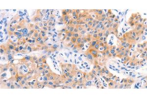 Immunohistochemistry of paraffin-embedded Human lung cancer tissue using Factor XIIIa Polyclonal Antibody at dilution 1:80 (F13A1 antibody)
