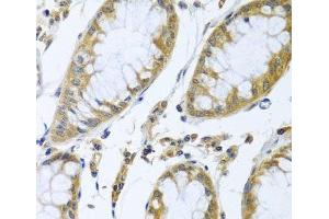 Immunohistochemistry of paraffin-embedded Human colon carcinoma using FBXL5 Polyclonal Antibody at dilution of 1:100 (40x lens). (FBXL5 antibody)