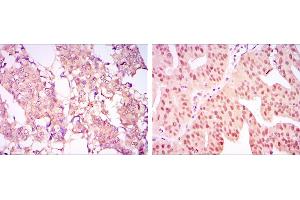 Immunohistochemical analysis of paraffin-embedded breast cancer tissues (left) and ovarian cancer tissues (right) using CARM1 mouse mAb with DAB staining. (CARM1 antibody)