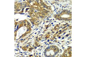 Immunohistochemistry of paraffin-embedded human gastric cancer using CDC16 antibody. (CDC16 antibody)