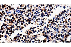 Immunohistochemistry of paraffin-embedded Human colon cancer tissue using ALOX5 Polyclonal Antibody at dilution 1:50 (ALOX5 antibody)