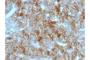 Formalin-fixed, paraffin-embedded human renal cell carcinoma stained with Cadherin 16 antibody (CDH16/1071) (Cadherin-16 antibody)