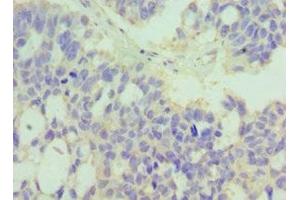 Immunohistochemistry of paraffin-embedded human endometrial cancer using ABIN7174047 at dilution of 1:100 (MERTK antibody  (AA 840-999))