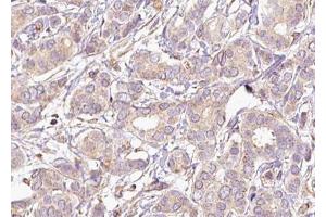 ABIN6267493 at 1/100 staining human breast carcinoma tissue sections by IHC-P. (MEK2 antibody  (pThr394))
