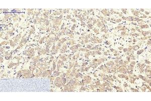 Immunohistochemistry of paraffin-embedded Human breast cancer tissue using ITGA2B Monoclonal Antibody at dilution of 1:200. (Integrin Alpha2b antibody)