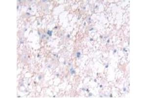 Detection of IFNa5 in Human Glioma Tissue using Monoclonal Antibody to Interferon Alpha 5 (IFNa5) (IFNA5 antibody  (AA 22-189))
