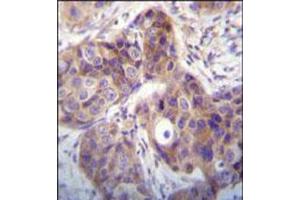 Immunohistochemical staining of formalin fixed and paraffin embedded human breast cancer was performed with KLK6 polyclonal antibody  at 1:10-1:50 dilution followed by indirect peroxidase conjugation with secondary antibody and DAB staining. (Kallikrein 6 antibody  (N-Term))