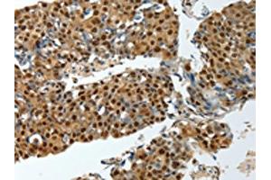 The image on the left is immunohistochemistry of paraffin-embedded Human breast cancer tissue using ABIN7193081(YBX1 Antibody) at dilution 1/15, on the right is treated with synthetic peptide. (YBX1 antibody)