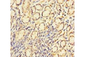 Immunohistochemistry of paraffin-embedded human gastric cancer using ABIN7148710 at dilution of 1:100 (CTDNEP1A antibody  (AA 3-244))