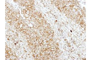 IHC-P Image Immunohistochemical analysis of paraffin-embedded human breast cancer, using EEN, antibody at 1:250 dilution.