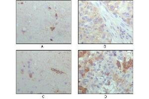 Immunohistochemical analysis of paraffin-embedded human brain hippocampus (A), lung cancer (B), brain tumor (C), breast cance (D), showing cytoplasmic localization with DAB staining using CRYAB antibody. (CRYAB antibody  (AA 1-175))