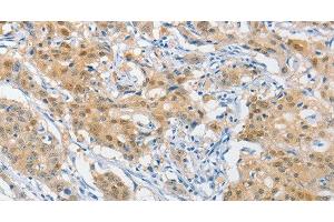 Immunohistochemistry of paraffin-embedded Human gastric cancer using HSP40 Polyclonal Antibody at dilution of 1:40 (DNAJB1 antibody)