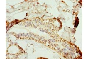 Immunohistochemistry of paraffin-embedded human breast cancer using ABIN7169124 at dilution of 1:100 (Nemo-Like Kinase antibody  (AA 278-527))