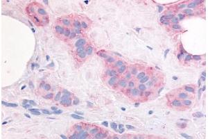 Human Breast Carcinoma (formalin-fixed, paraffin-embedded) stained with VEGFR2 antibody ABIN213631 at 10 ug/ml followed by biotinylated goat anti-rabbit IgG secondary antibody ABIN481713, alkaline phosphatase-streptavidin and chromogen. (VEGFR2/CD309 antibody  (Internal Region))