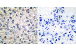 Peptide - +Immunohistochemical analysis of paraffin-embedded human breast carcinoma tissue using Catenin-α antibody. (CTNNA1 antibody)