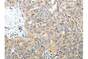 The image on the left is immunohistochemistry of paraffin-embedded Human ovarian cancer tissue using ABIN7130809(RAMP3 Antibody) at dilution 1/40, on the right is treated with fusion protein. (RAMP3 antibody)