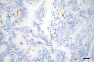 Immunohistochemistry was performed on paraffin-embedded human endometrial carcinoma using phospho-vimentin (S39) antibody (ABIN7800837), 1:200).