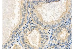 ABIN6264184 and ABIN6272389 at 1/100 staining Human ovarian cancer and adjacent normal tissues by IHC-P.