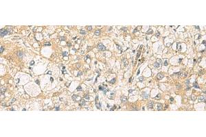 Immunohistochemistry of paraffin-embedded Human liver cancer tissue using DNAJA4 Polyclonal Antibody at dilution of 1:55(x200) (DNAJA4 antibody)