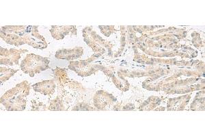 Immunohistochemistry of paraffin-embedded Human thyroid cancer tissue using EPRS Polyclonal Antibody at dilution of 1:60(x200) (EPRS antibody)