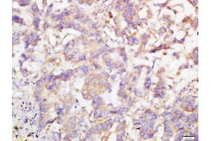 Formalin-fixed and paraffin embedded human lung cancer labeled with Rabbit Anti-TRIB2 Polyclonal Antibody, Unconjugated  at 1:200 followed by conjugation to the secondary antibody and DAB staining (TRIB2 antibody  (AA 151-250))