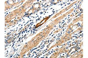 The image on the left is immunohistochemistry of paraffin-embedded Human gastric cancer tissue using ABIN7192673(STEAP4 Antibody) at dilution 1/25, on the right is treated with synthetic peptide. (STEAP4 antibody)