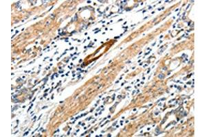 The image on the left is immunohistochemistry of paraffin-embedded Human gastric cancer tissue using ABIN7192673(STEAP4 Antibody) at dilution 1/25, on the right is treated with synthetic peptide. (STEAP4 antibody)