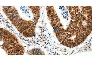 Immunohistochemistry of paraffin-embedded Human colon cancer tissue using SP1 Polyclonal Antibody at dilution 1:30 (SP1 antibody)