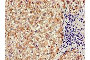 Immunohistochemistry of paraffin-embedded human liver cancer using ABIN7170291 at dilution of 1:100 (SLCO1B3 antibody  (AA 648-695))