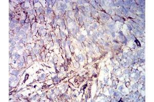 Immunohistochemical analysis of paraffin-embedded bladder cancer tissues using CD44 mouse mAb with DAB staining. (CD44 antibody  (AA 36-194))
