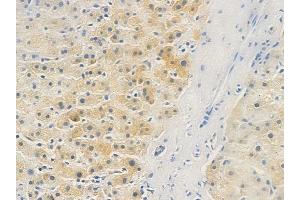 ABIN6263832 and ABIN6272711 at 1/100 staining human hepatocellular carcinoma by IHC-P.